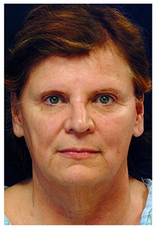 Facelift Before Photo by Michael Law, MD; Raleigh, NC - Case 33740