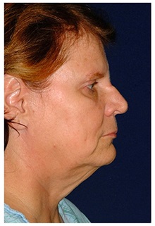 Facelift Before Photo by Michael Law, MD; Raleigh, NC - Case 33740