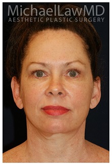 Facelift After Photo by Michael Law, MD; Raleigh, NC - Case 33741