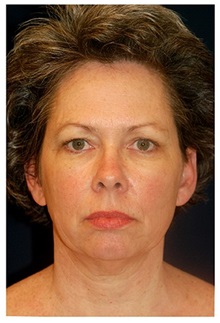 Facelift Before Photo by Michael Law, MD; Raleigh, NC - Case 33741