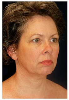 Facelift Before Photo by Michael Law, MD; Raleigh, NC - Case 33741