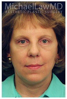 Facelift After Photo by Michael Law, MD; Raleigh, NC - Case 33743