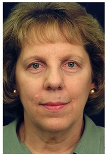 Facelift Before Photo by Michael Law, MD; Raleigh, NC - Case 33743
