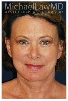 Facelift After Photo by Michael Law, MD; Raleigh, NC - Case 33744