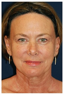 Facelift Before Photo by Michael Law, MD; Raleigh, NC - Case 33744