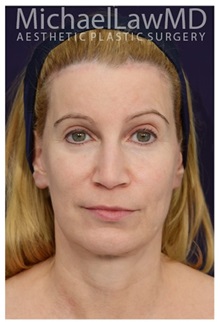 Facelift After Photo by Michael Law, MD; Raleigh, NC - Case 33745