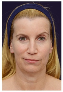 Facelift Before Photo by Michael Law, MD; Raleigh, NC - Case 33745