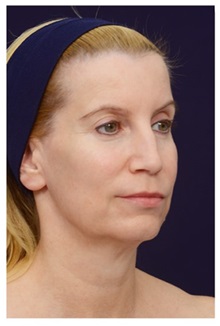 Facelift Before Photo by Michael Law, MD; Raleigh, NC - Case 33745