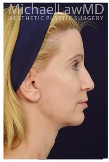 Facelift After Photo by Michael Law, MD; Raleigh, NC - Case 33745
