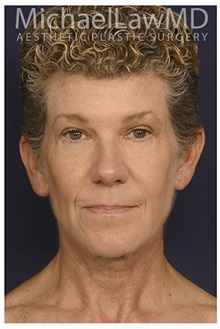 Facelift After Photo by Michael Law, MD; Raleigh, NC - Case 33746