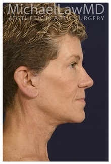 Facelift After Photo by Michael Law, MD; Raleigh, NC - Case 33746