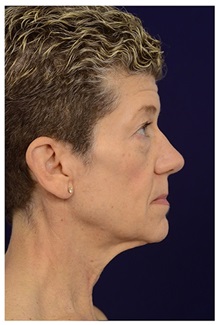 Facelift Before Photo by Michael Law, MD; Raleigh, NC - Case 33746