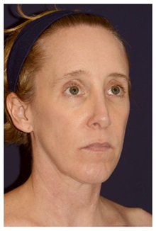 Facelift Before Photo by Michael Law, MD; Raleigh, NC - Case 33747