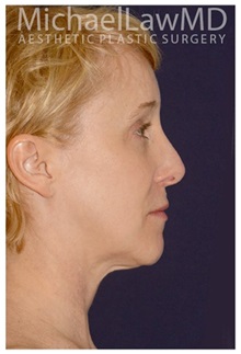 Facelift After Photo by Michael Law, MD; Raleigh, NC - Case 33747