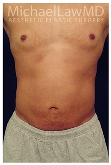 Liposuction After Photo by Michael Law, MD; Raleigh, NC - Case 33752