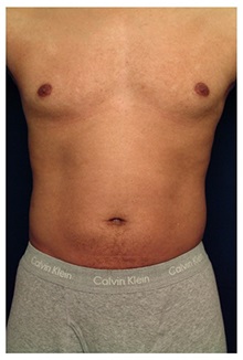 Liposuction Before Photo by Michael Law, MD; Raleigh, NC - Case 33752