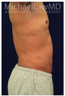 Liposuction After Photo by Michael Law, MD; Raleigh, NC - Case 33752
