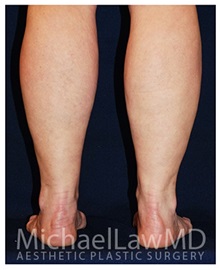 Liposuction After Photo by Michael Law, MD; Raleigh, NC - Case 33814