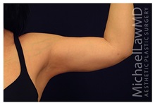 Liposuction After Photo by Michael Law, MD; Raleigh, NC - Case 33823