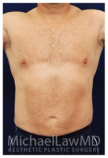 Liposuction After Photo by Michael Law, MD; Raleigh, NC - Case 33828