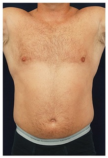 Liposuction Before Photo by Michael Law, MD; Raleigh, NC - Case 33828
