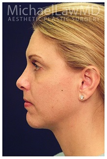 Liposuction After Photo by Michael Law, MD; Raleigh, NC - Case 33838