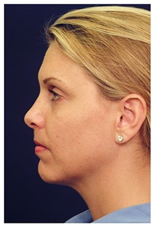 Liposuction Before Photo by Michael Law, MD; Raleigh, NC - Case 33838
