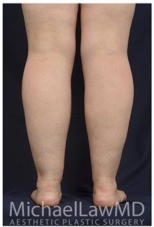 Liposuction After Photo by Michael Law, MD; Raleigh, NC - Case 33847
