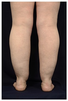Liposuction Before Photo by Michael Law, MD; Raleigh, NC - Case 33847