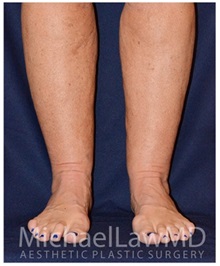 Liposuction After Photo by Michael Law, MD; Raleigh, NC - Case 33855