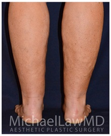 Liposuction After Photo by Michael Law, MD; Raleigh, NC - Case 33855
