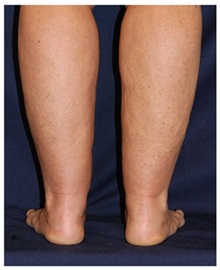 Liposuction Before Photo by Michael Law, MD; Raleigh, NC - Case 33855