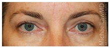 Eyelid Surgery After Photo by Michael Law, MD; Raleigh, NC - Case 33872