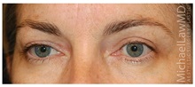 Eyelid Surgery After Photo by Michael Law, MD; Raleigh, NC - Case 33872