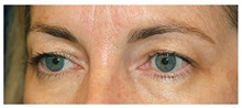 Eyelid Surgery Before Photo by Michael Law, MD; Raleigh, NC - Case 33872