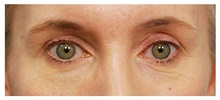 Eyelid Surgery Before Photo by Michael Law, MD; Raleigh, NC - Case 33873