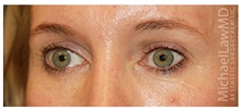 Eyelid Surgery After Photo by Michael Law, MD; Raleigh, NC - Case 33873
