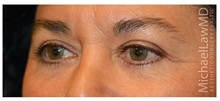Eyelid Surgery After Photo by Michael Law, MD; Raleigh, NC - Case 33874