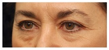 Eyelid Surgery Before Photo by Michael Law, MD; Raleigh, NC - Case 33874