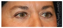Eyelid Surgery After Photo by Michael Law, MD; Raleigh, NC - Case 33874