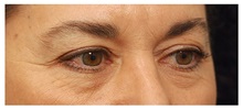 Eyelid Surgery Before Photo by Michael Law, MD; Raleigh, NC - Case 33874