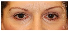 Eyelid Surgery After Photo by Michael Law, MD; Raleigh, NC - Case 33875