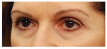 Eyelid Surgery Before Photo by Michael Law, MD; Raleigh, NC - Case 33875