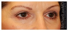 Eyelid Surgery After Photo by Michael Law, MD; Raleigh, NC - Case 33875