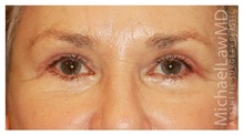 Eyelid Surgery After Photo by Michael Law, MD; Raleigh, NC - Case 33878