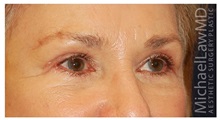 Eyelid Surgery After Photo by Michael Law, MD; Raleigh, NC - Case 33878