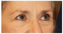 Eyelid Surgery Before Photo by Michael Law, MD; Raleigh, NC - Case 33878