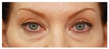 Eyelid Surgery Before Photo by Michael Law, MD; Raleigh, NC - Case 33879