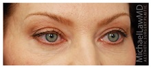 Eyelid Surgery After Photo by Michael Law, MD; Raleigh, NC - Case 33879