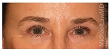 Eyelid Surgery After Photo by Michael Law, MD; Raleigh, NC - Case 33880